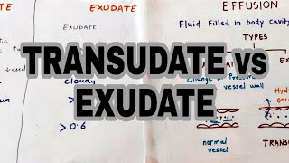 Transudate vs Exudate  Types of effusion  lights criteria [upl. by Mic]