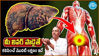 10 Symptoms of Liver Problem  Fatty Liver Symptoms  liver damage Sign  Prakruthi Vanam Prasad [upl. by Yenhoj]