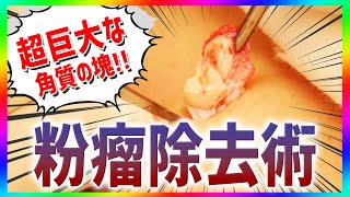 【閲覧注意】凄腕美容外科医もビックリ！角質が詰まった超巨大な粉瘤をにゅるっと取り出す！【粉瘤除去術】The Cyst Bomb Removal of cystsEpidermoid cyst [upl. by Whiney399]