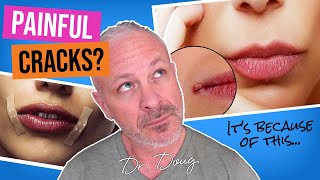 Why do I have CRACKED MOUTH CORNERS Angular Cheilitis  Dr Doug Willen [upl. by Oirasan]