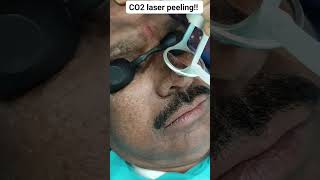 CO2 laser peeling [upl. by Enomis]