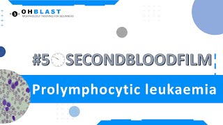 50SecondBloodFilm Prolymphocytic leukaemia [upl. by Witt]