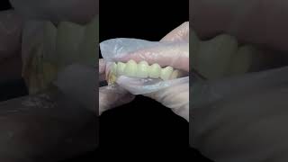 Porcelain Fused to Metal PFM Dental Bridge dentist dentallab dentalclinic smilemakeover [upl. by Llerrud480]