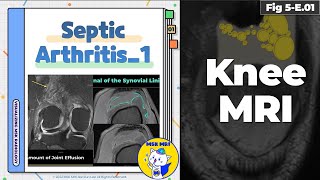 Fig 5E01 Earliest Findings of Septic Arthritis [upl. by Avehs413]