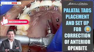 Palatal TADs Placement  Correction of Anterior Openbite  Miniscrews  MiniImplant  SAS  TAD [upl. by Kelley]