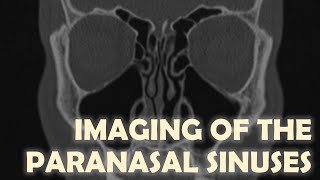 Imaging Anatomy of the Paranasal Sinuses [upl. by Lorilyn]