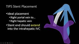 TIPS Stent US Doppler Evaluation [upl. by Otrebogad]