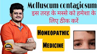 Molluscum contagiosum  Best Homeopathic Medicine  इस तरह के मस्से को हमेशा के लिए ठीक करें [upl. by Kissel]