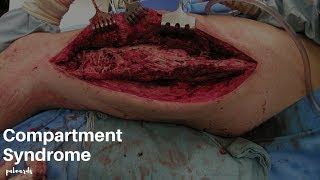 Emergency Medical Treatment Compartment Syndrome [upl. by Delaney]