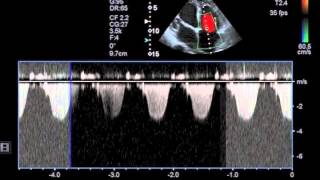 Myocarditis [upl. by Hotchkiss]