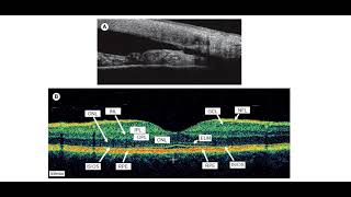 Kanski Clinical Ophthalmology Made Easy  Macula 5 A [upl. by Hoeg]