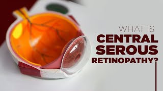 What is Central Serous Retinopathy  Symptoms Prevention Treatment and More [upl. by Ainegul]