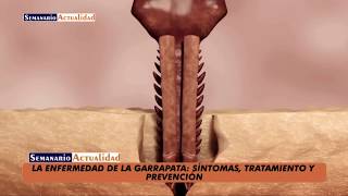 La enfermedad de la garrapata Síntomas tratamiento y prevención [upl. by Nivert]