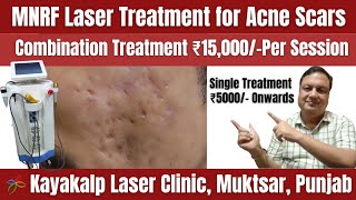 MNRF Laser Treatment for Acne Scar  Cost and Sessions  Acne Scar [upl. by Coward]