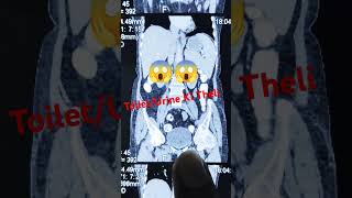 Urinary bladder Show In CT Scan radiology reels shortvideo shorts trending trendingshorts [upl. by Oisinoid227]