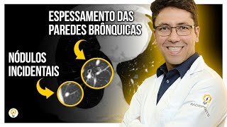 ACHADOS PULMONARES na Tomografia de Tórax Paciente de 60 anos [upl. by Rog]