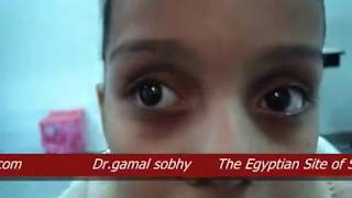 Intermittent Exotropia  الحول الوحشي المتقطع [upl. by Meakem]