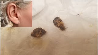 Does EARWAX Alone Cause Temporary Complete HEARING Loss Ear Wax Removal Cant Hear Crackling Cerumen [upl. by Meehyr]