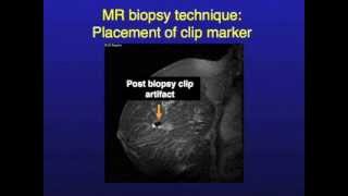 UCSF Radiology How MRI Image Guided Breast Biopsies Are Done [upl. by Nafets]