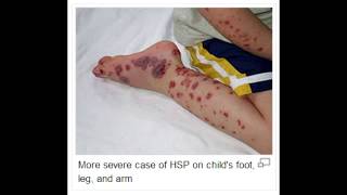 HenochSchonlein Purpura IgA vasculitis affecting skin and kidneys [upl. by Coryden]