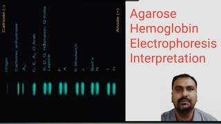 Hemoglobin electrophoresis Interpretation [upl. by Gearhart165]