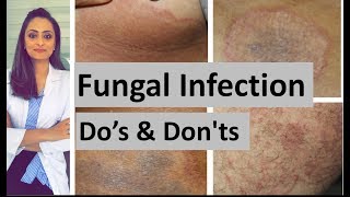 Fungal infection of skin  Dos and Donts  Dermatologist  Dr Aanchal Panth [upl. by Einiffit]