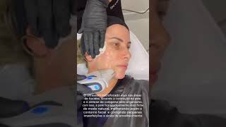 Aplicação UltramedUltraformer facial  Ultrassom microfocado [upl. by Cypro]