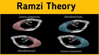 Ramzi theory of gender prediction [upl. by Allicirp]