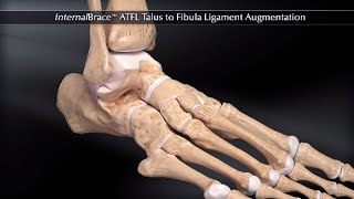 InternalBrace™ ATFL Talus to Fibula Ligament Augmentation [upl. by Lowenstern]