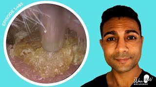 1485  Masses of Dead Skin Removed from Both Ears  Learn About Different Ear Wax Drops [upl. by Arem]