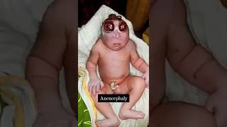 Anencephaly youtubeshorts viral newborn paediatrics birth medical trending doctor obgyn kb [upl. by Roy]