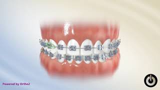 Elastics Midline UR3LL3  Dental Braces  Temecula Valley CA [upl. by Ybrik]