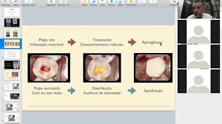 Endodontia de Dentes Decíduos [upl. by Peggir]
