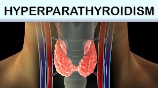 Hyperparathyroidism Medical Animation [upl. by Aisatnaf]