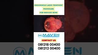 Most Demanding Endovenous Laser Treatment Procedure [upl. by Horne534]