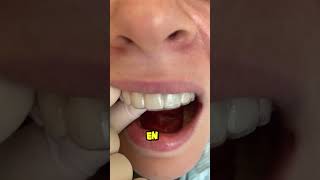 un implante dental es mejor que un diente natural dientes dentista tips parati viral fyp [upl. by Notsreik]