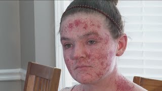 Georgia woman battles pain after using steroid cream [upl. by Pavior]