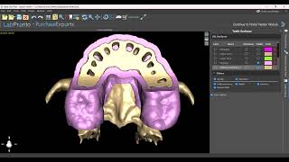 Bone Reduction Guide Templates and Prosthetic Spacers Video [upl. by Jonathan112]