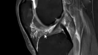 Hoffa Disease  Knee MRI [upl. by Baiss]