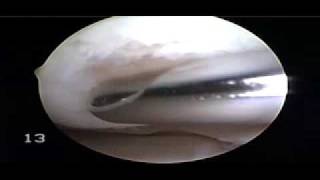 Chondroplasty and Drilling  Dr Steven Struhl [upl. by Maggs]