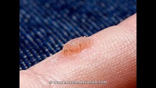 How to Remove Common Hand Warts  Wart amp Mole Vanish [upl. by Ehctav33]