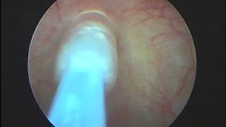 Cryosurgery of bladder [upl. by Naeroled]