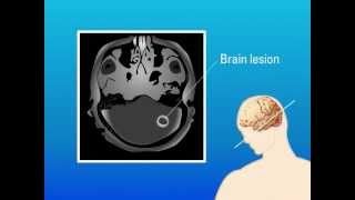 Extrapulmonary Aspergillosis – Type of Fungal Infection [upl. by Davis21]