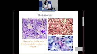 systemic mycoses by Dr C J Lyngdoh NEIGHRIMS Shillong [upl. by Patrizius]