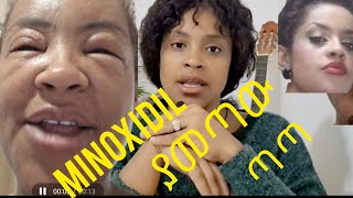 minoxidil ፀጉር ማሳደጊያ ያመጣው ጣጣ [upl. by Angel]