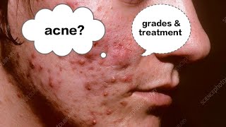 Acne Vulgaris  common problem [upl. by Ahlgren409]