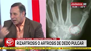 ¿Qué es la rizartrosis o la artrosis en el dedo pulgar [upl. by Trumann692]