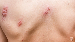 Mayo Clinic Minute Dont suffer with shingles [upl. by Telracs882]