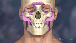 Mayo Clinic’s First Face Transplant The Surgery [upl. by Sulecram]