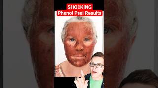 CRAZY CHEMICAL PEEL  Phenol Peel Before and After shorts [upl. by Aneelas]